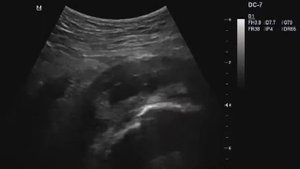 Подвздошно гребешковый бурсит