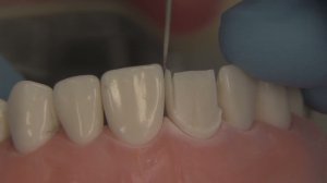 Препарирование центрального резца верхней челюсти под металлокерамическую коронку