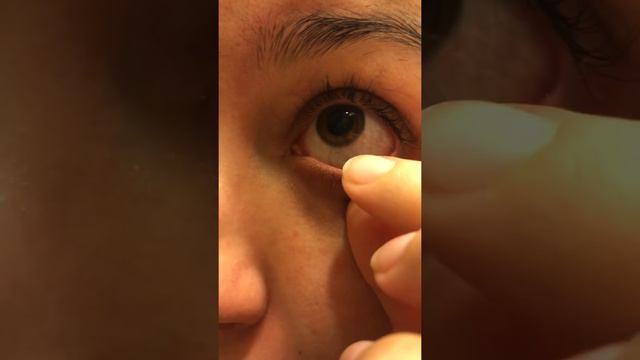 Satisfying Eye String Removal From Eye Allergies