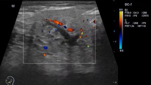 Калькулезный сиалоаденит