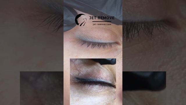 Удаление стрелок ремувером Jet Remove в Москве