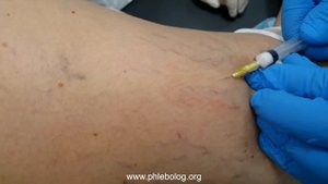 Пенная микросклеротерапия сосудистых звездочек