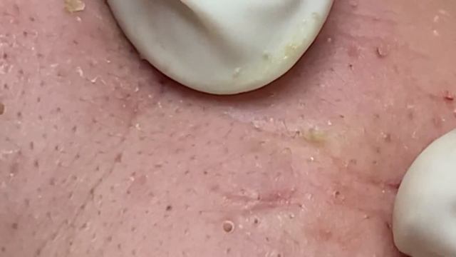 Acne treatment for Spa Linh Mun 2023 #003 смотреть онлайн