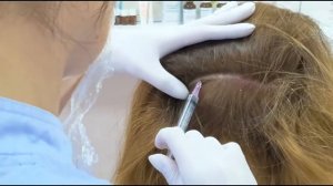 Мезотерапия кожи головы и рук