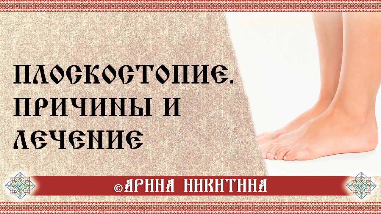 Причины плоскостопия |  Лечение плоскостопия | Как убрать плоскостопие | Арина Никитина