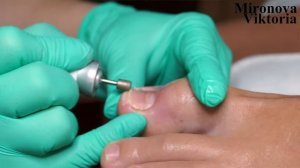 Работа с вросшим ногтём / В гостях у Оксаны Луцай/ Часть 2