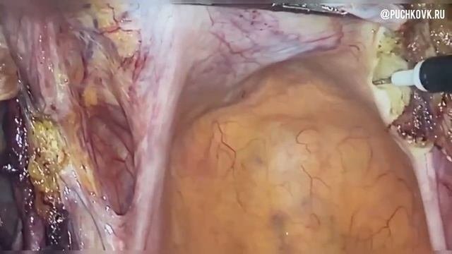 Рак эндометрия  Лапароскопическая пангистерэктомия с тазовой лимфаденэктомией при раке эндометрия