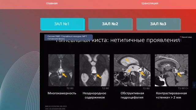 Случайные находки МРТ головного мозга 1 часть