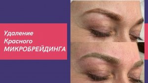 Как удалить МИКРОБЛЕЙДИНГ БРОВЕЙ? Лазерное удаление микроблейдинга бровей. Процесс и результат.