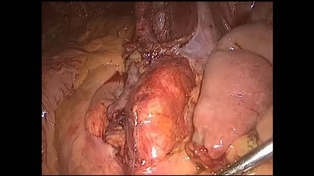 Лапароскопическая цистэктомия. Этап формирования кондуита по Брикеру с илеоанастомозом по Уоллесу. смотреть онлайн