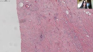 56. Инвазивный дольковый рак