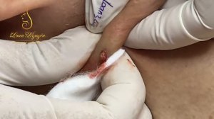 Remove big CYST and SUC 20 years (344) | Loan nguyen