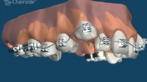 Как работает брекет система