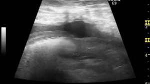 Рак шейки матки