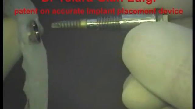 Guided Implantology NewConcepts WO2010125593 A1 case 2