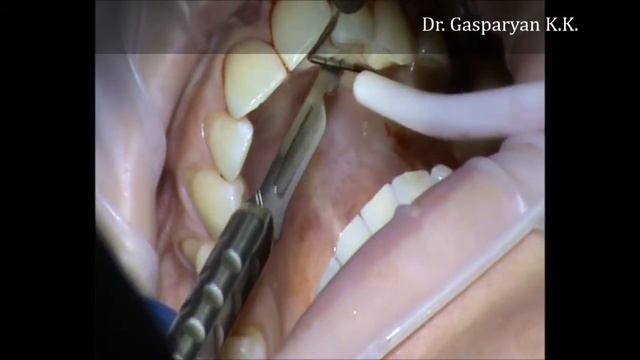 Устранение рецесси десны (recession elimination) смотреть онлайн