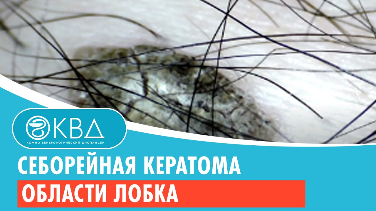 Себорейная кератома области лобка. Клинический случай №7