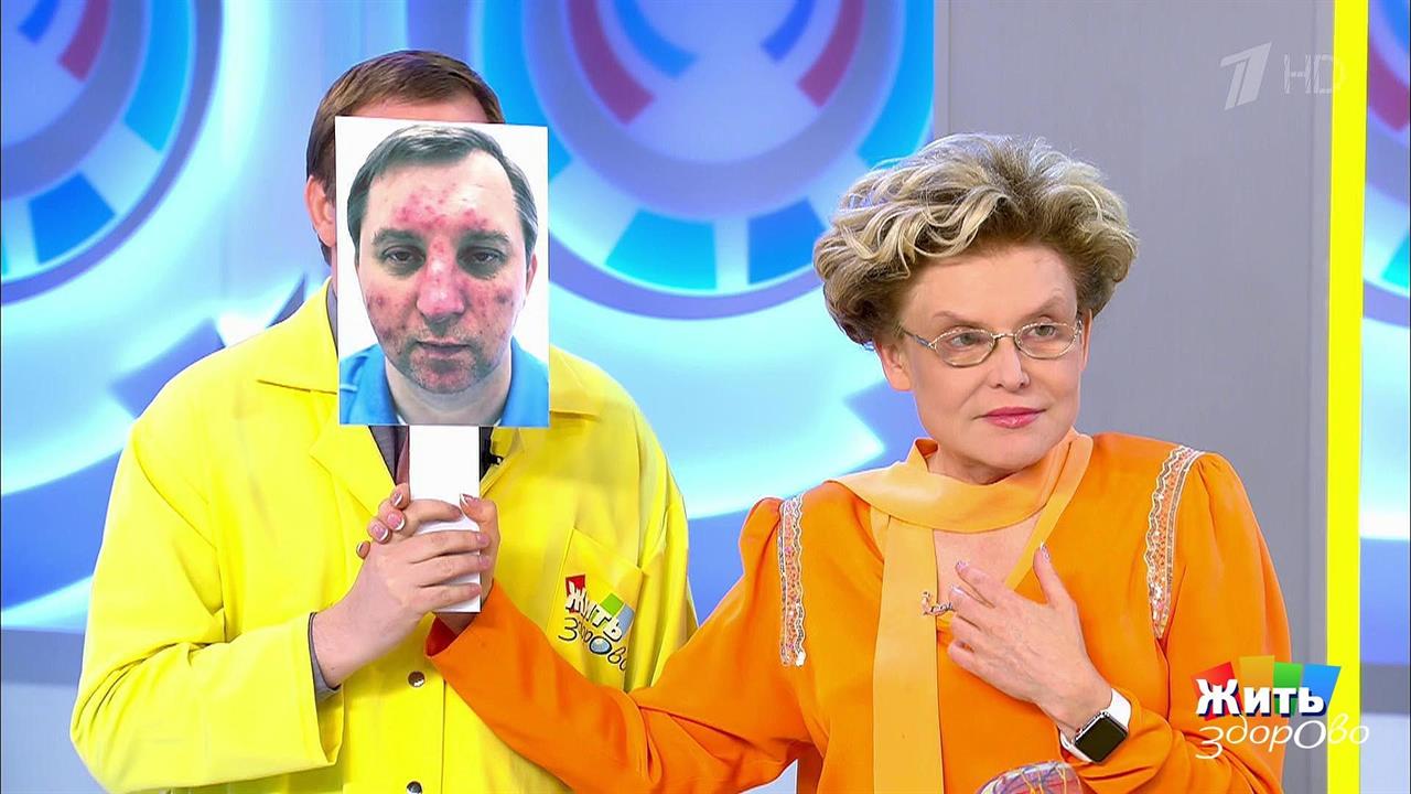 Розацеа. Жить здорово! Фрагмент выпуска от 21.08.2018