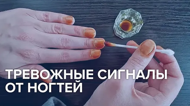 Тревожные сигналы от ногтей