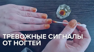 Тревожные сигналы от ногтей
