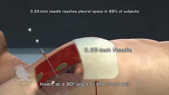 ARS® For Needle Decompression смотреть онлайн