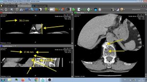 КТ "ПОЗВОНОЧНИКА" .