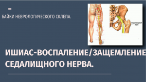 Ишиас. Воспаление,защемление седалищного нерва.