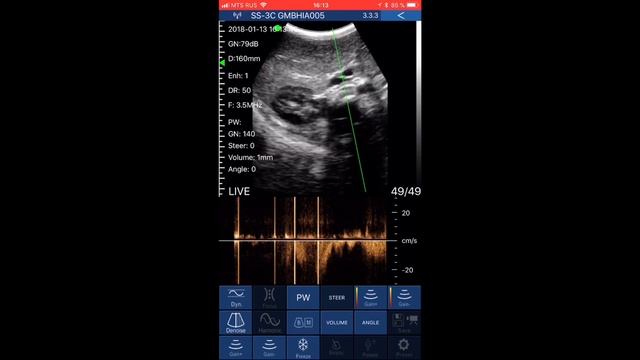 Распаковка и краткий обзор компактного ультразвукового сканера Sonostar Wireless ultrasound