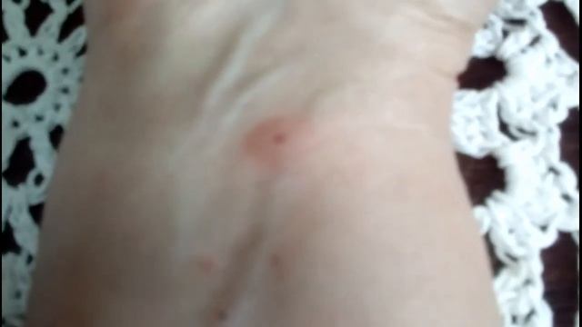 Как очень быстро убрать последствия укуса МОШКИ. смотреть онлайн