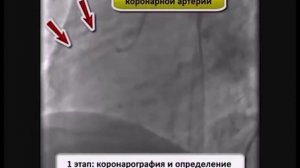 Патогенетическая терапия ишемической болезни сердца