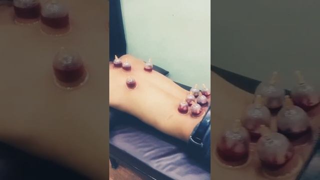 Back pain || Cupping Therapy || #cupping смотреть онлайн