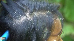 Dandruff Shampoo And Scratching - Itchy Psoriasis treatment #301