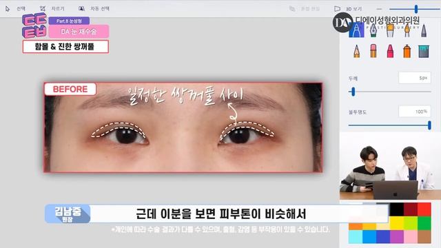 Повторная пластика глаз, клиника DA поможет вернуть красоту глаз. смотреть онлайн