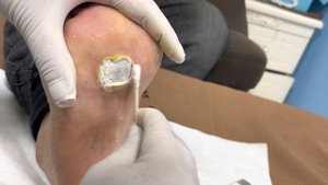 Pedicure:Treatment of Plantar Warts【Foot scalpel】