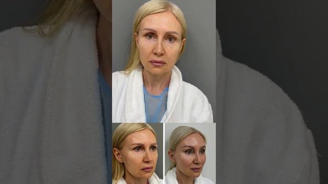 Подтяжка лица, подтяжка шеи, омоложение