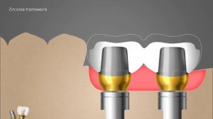 Dentium Implantium