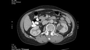 КТ органов брюшной полости. Ваше мнение?