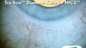 TruSize™ Diamond Knife