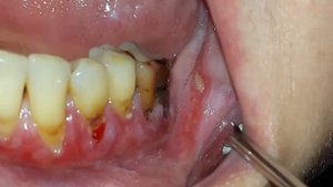 Лекция "Заболевания слизистой оболочки рта"