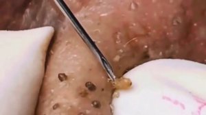 ✅ Выдавливание прыщей #20