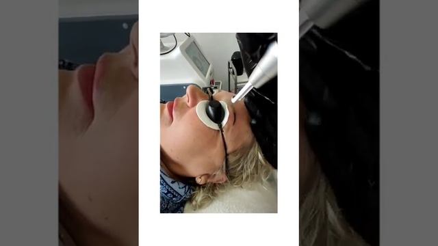 Удаление татуажа бровей пикосекундным лазером Studio Estetic Рината Сафина г. Сочи