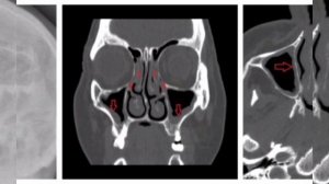 Интерпретация результатов КТ-ОНП,Височных костей#лорврач #медицина#кмв