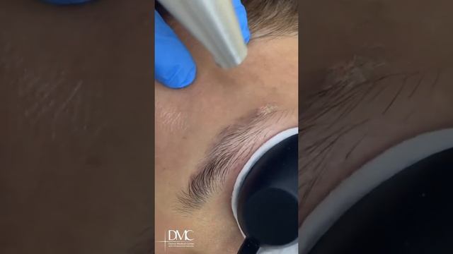 Лазерное удаление татуажа бровей! смотреть онлайн