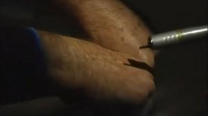 удаление пигментации наконечником сканером