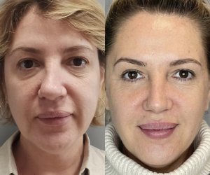 Ринопластика: ДО и ПОСЛЕ