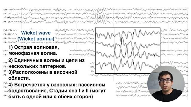 ЭЭГ варианты нормы VS Эпилептиформные паттерны