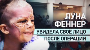 «У меня теперь нормальная кожа»: Луне Феннер сняли швы после операции по удалению родимого пятна