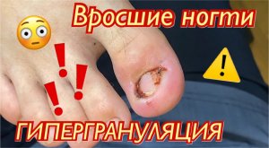 Вросшие ногти?⚠️❗️ • ГИПЕРГРАНУЛЯЦИЯ ???