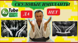 Имплант 7.Скуловые импланты в стоматологии! Что это такое?  #имплант #имплантация зубов #Стоматолог