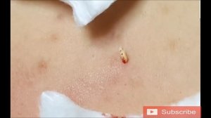 Давим Прыщи На Спине Жесть!!! Как Много Червей!!!